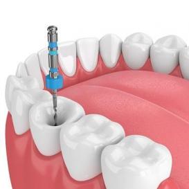 Root Canal Treatment